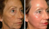 2 maneras fáciles para eliminar arrugas en la cara en casa sin cirugía y sin esteticista