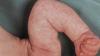 Piel "mármol" en bebés: ¿norma o patología? Respuestas del neurólogo