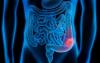 Los pólipos en el intestino: 4 primera característica