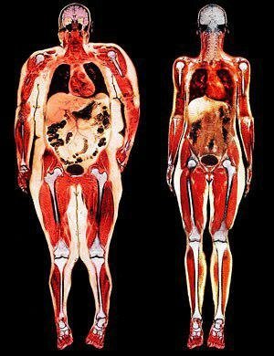Izquierda - acaba de obesidad visceral. Todos los órganos cubiertas con grasa.
