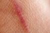 Las cicatrices en la piel: qué es y cómo eliminarlos