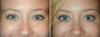 ¿Qué combinación de procedimientos cosméticos se bombichesky efecto para la cara