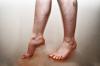 Violación del flujo sanguíneo en las piernas: causas, síntomas