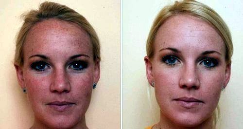 Peeling de carbono. Fotos de antes y después. El paciente tiene el tipo de piel grasa.