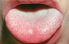 Lo que hace la placa blanca en la lengua?