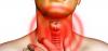 Tuberculosis de la laringe: los primeros signos de