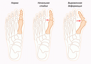 Cómo quitar un hueso en el pie