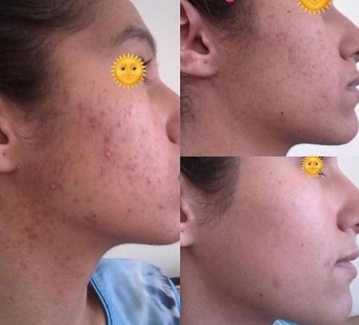 El tratamiento del acné enzimas