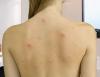 ¿Cómo deshacerse de acné en la espalda