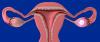 Los quistes de ovario: síntoma 4 alarma