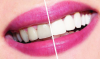 Cómo blanquear los dientes en casa? consejos dental.