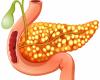 Importantes signos de mala salud del páncreas