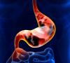 Cáncer de estómago: cómo identificar la enfermedad en una etapa temprana? 00