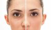 4 herramientas de gran alcance para deshacerse de los poros en la cara