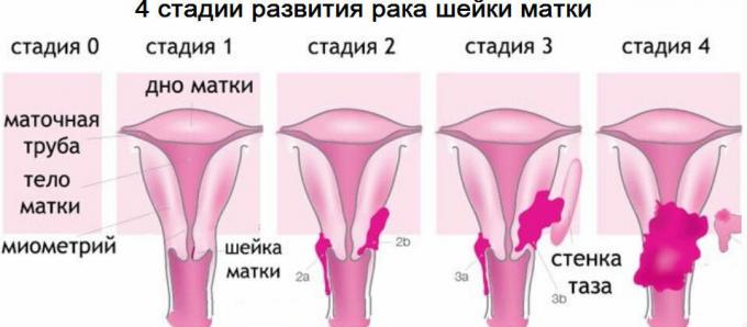 4 etapas de cáncer de cuello uterino
