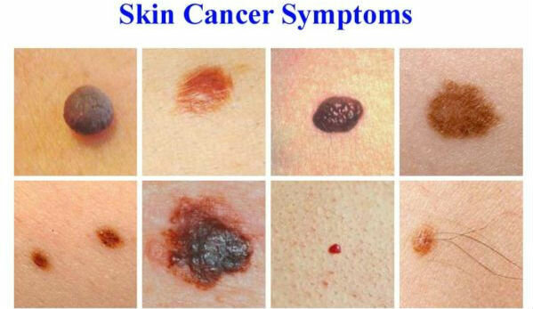 Los síntomas de cáncer de piel