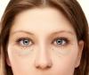 ¿Cómo deshacerse de sin necesidad de cirugía, una hernia y los párpados inferiores bolsas de los ojos