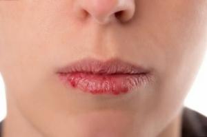5 consejos sobre cómo prevenir el agrietamiento de los labios